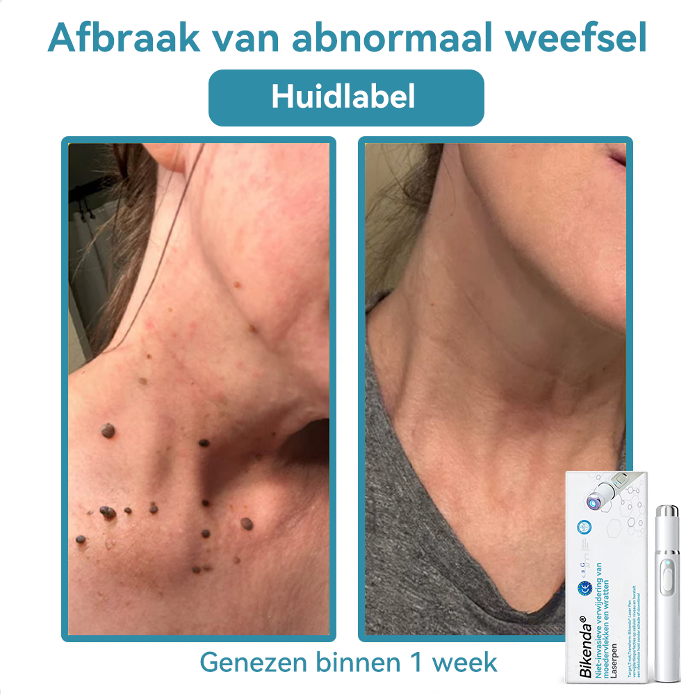 Bikenda® Laserpen – Verwijder Moedervlekken & Wratten Thuis