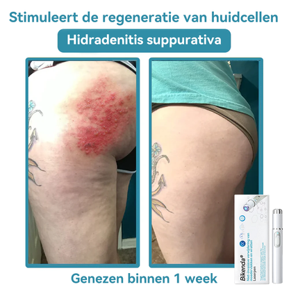 Bikenda® Laserpen – Verwijder Moedervlekken & Wratten Thuis