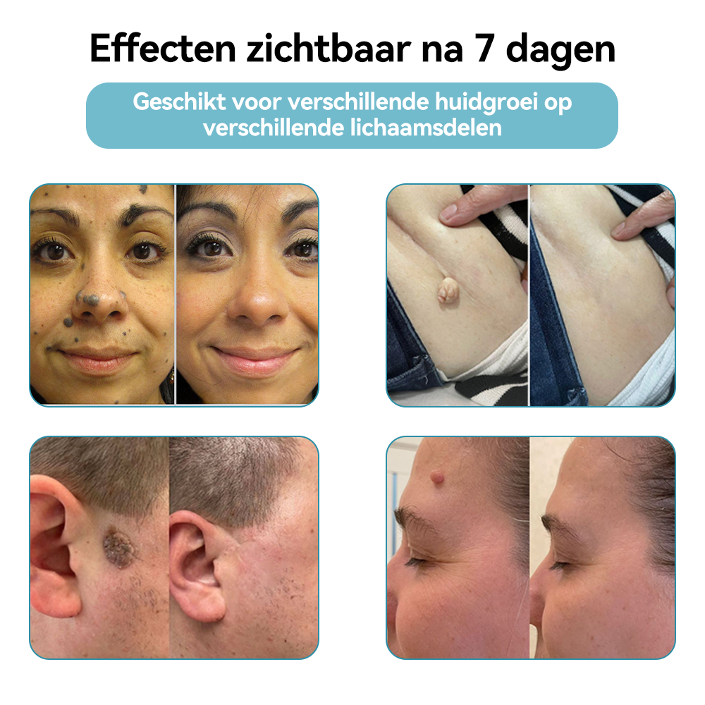 Bikenda® Laserpen – Verwijder Moedervlekken & Wratten Thuis