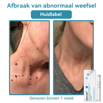 Bikenda® Laserpen – Verwijder Moedervlekken & Wratten Thuis