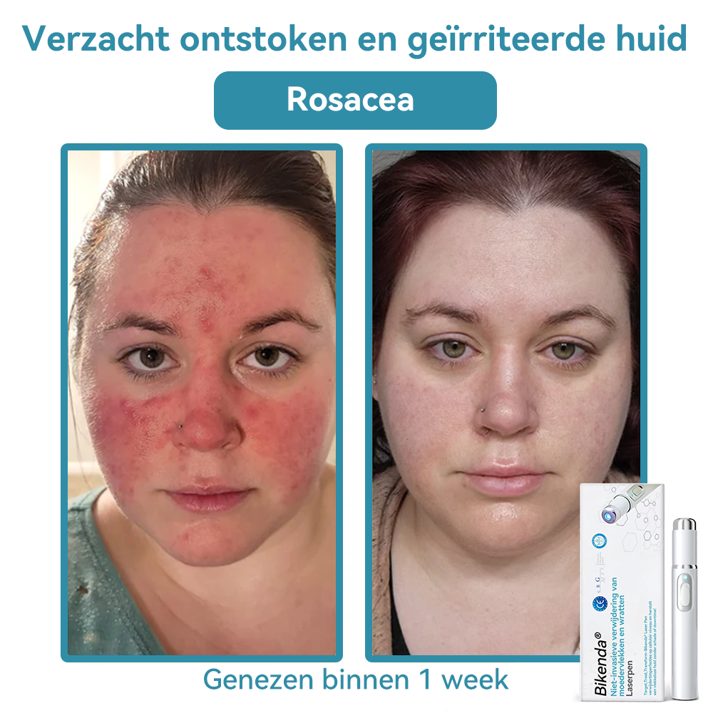 Bikenda® Laserpen – Verwijder Moedervlekken & Wratten Thuis