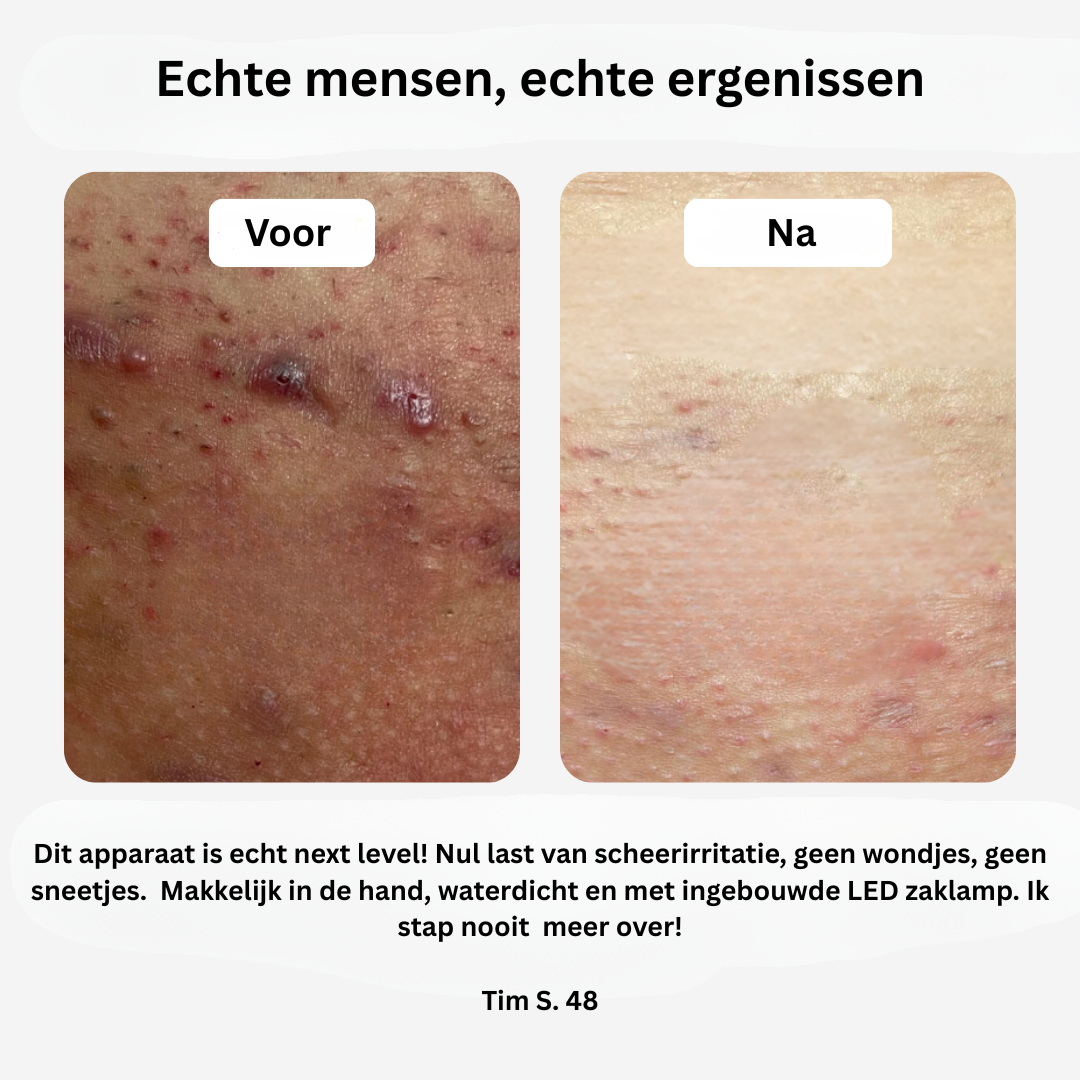 SmoothTrim™ – Voor lichaams- en intieme verzorging