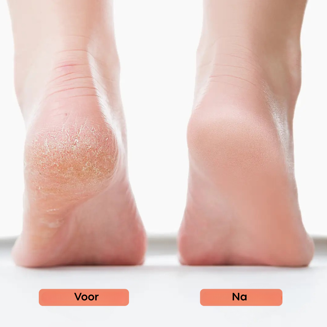PediCare™ - Zachte, gezonde voeten in minuten