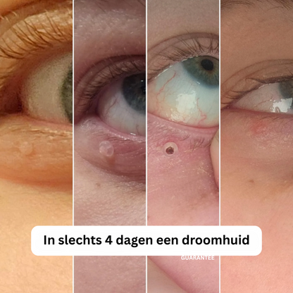 Alcura™ Complete Set – Geen huidflapjes meer