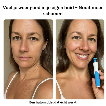 Alcura™ Complete Set – Geen huidflapjes meer